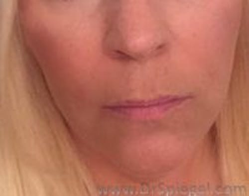 Lip Lift Before & After Gallery - Patient 386067 - Image 1