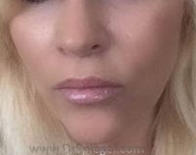 Lip Lift Before & After Gallery - Patient 386067 - Image 2