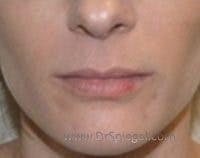 Lip Lift Before & After Gallery - Patient 302045 - Image 1