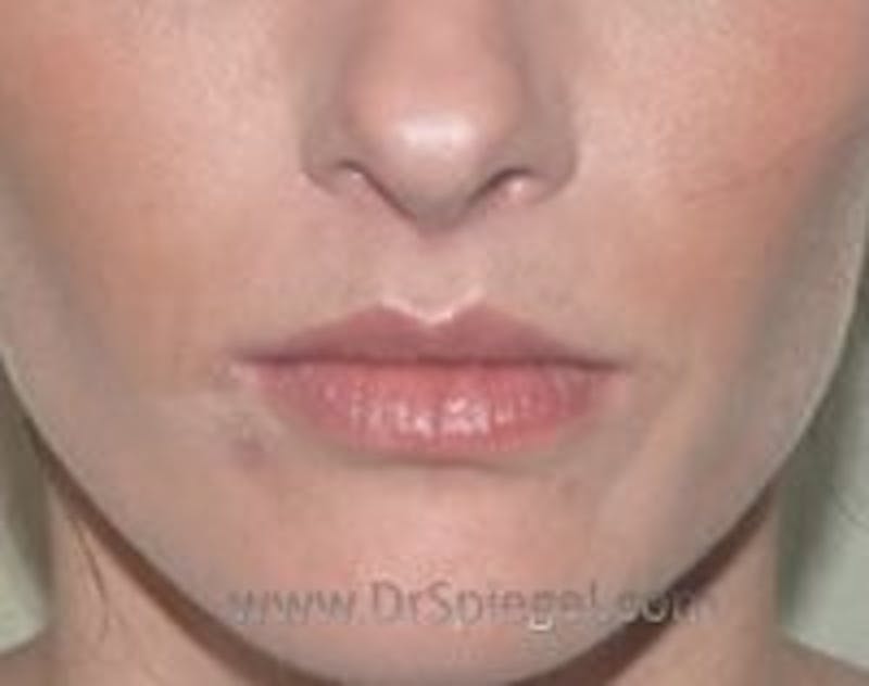 Lip Lift Before & After Gallery - Patient 302045 - Image 2