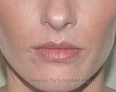 Lip Lift Before & After Gallery - Patient 302045 - Image 2