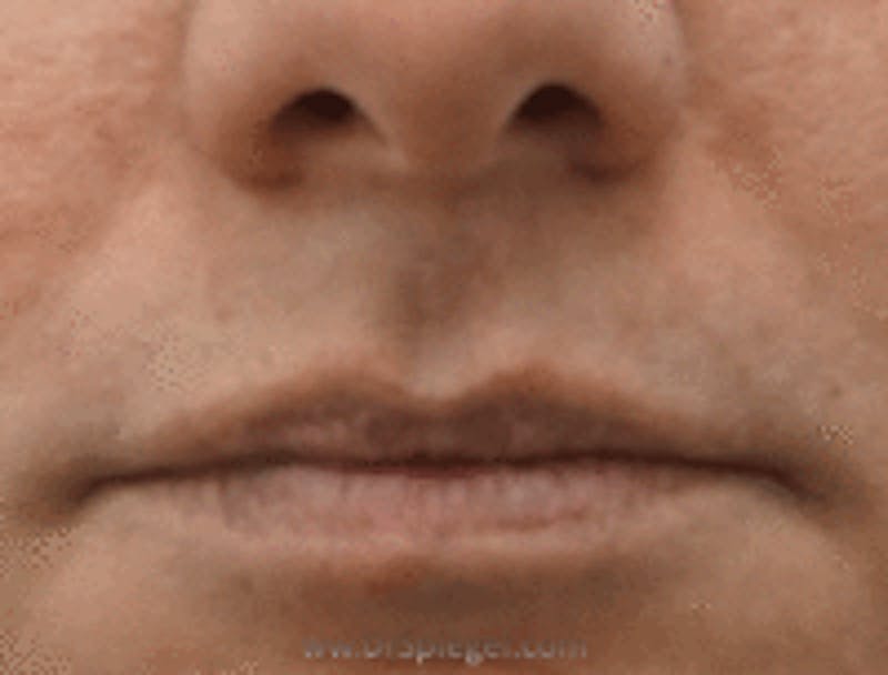 Lip Lift Before & After Gallery - Patient 368546 - Image 1