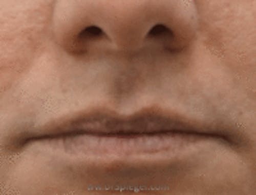 Lip Lift Before & After Gallery - Patient 368546 - Image 1