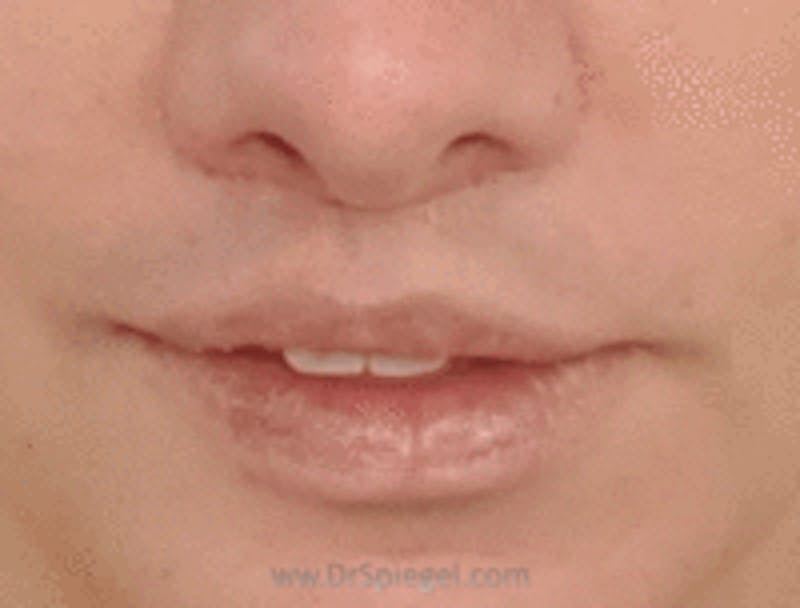 Lip Lift Before & After Gallery - Patient 368546 - Image 2