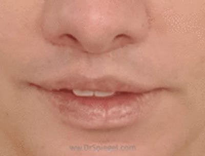 Lip Lift Before & After Gallery - Patient 368546 - Image 2