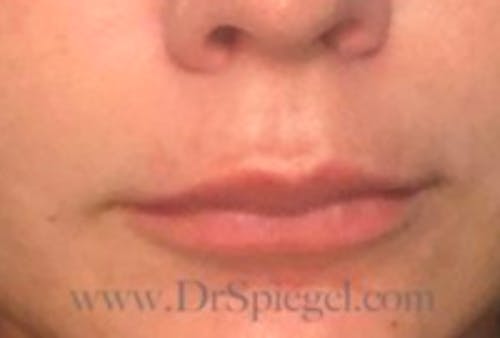 Lip Lift Before & After Gallery - Patient 265530 - Image 1
