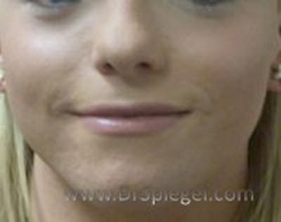 Lip Lift Before & After Gallery - Patient 230820 - Image 1