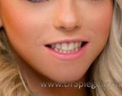 Lip Lift Before & After Gallery - Patient 230820 - Image 2