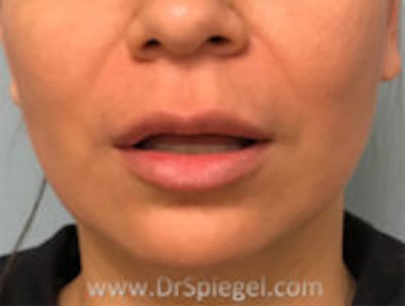 Lip Lift Before & After Gallery - Patient 118251 - Image 1