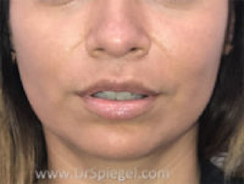 Lip Lift Before & After Gallery - Patient 118251 - Image 2