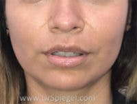 Lip Lift Before & After Gallery - Patient 118251 - Image 2