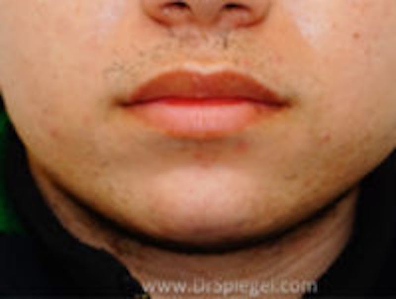 Lip Lift Before & After Gallery - Patient 122792 - Image 1