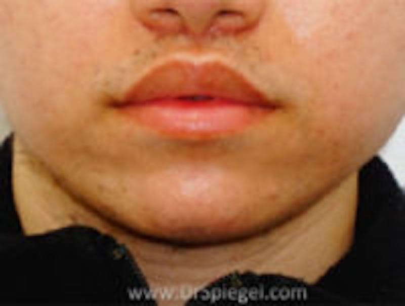 Lip Lift Before & After Gallery - Patient 122792 - Image 2