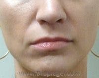 Lip Lift Before & After Gallery - Patient 307867 - Image 1