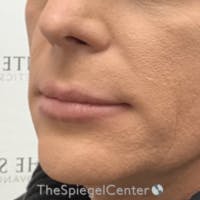 Lip Lift Before & After Gallery - Patient 188251 - Image 1