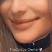 Lip Lift Before & After Gallery - Patient 188251 - Image 2