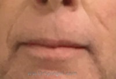 Lip Lift Before & After Gallery - Patient 209871 - Image 1