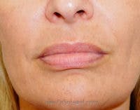 Lip Lift Before & After Gallery - Patient 234997 - Image 1