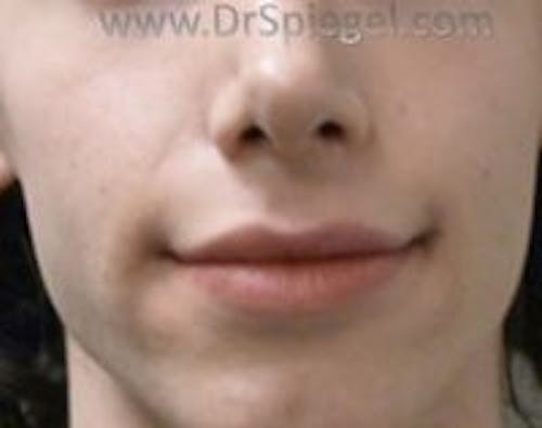 Lip Lift Before & After Gallery - Patient 306720 - Image 1