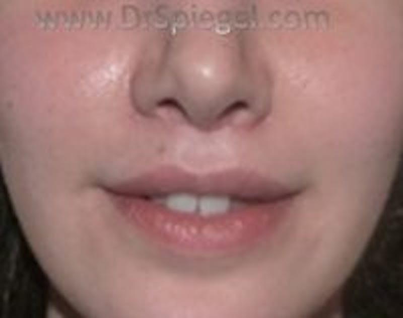 Lip Lift Before & After Gallery - Patient 306720 - Image 2
