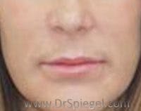 Lip Lift Before & After Gallery - Patient 872907 - Image 1