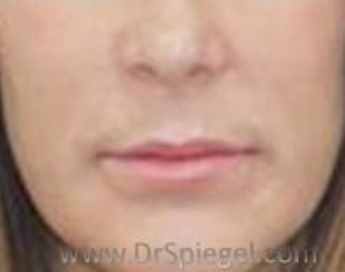Lip Lift Before & After Gallery - Patient 872907 - Image 1