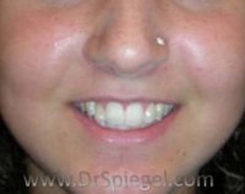 Lip Lift Before & After Gallery - Patient 217977 - Image 1