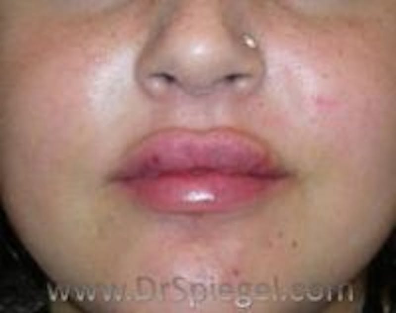 Lip Lift Before & After Gallery - Patient 217977 - Image 2