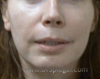 Lip Lift Before & After Gallery - Patient 326649 - Image 1