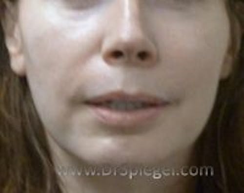 Lip Lift Before & After Gallery - Patient 326649 - Image 1
