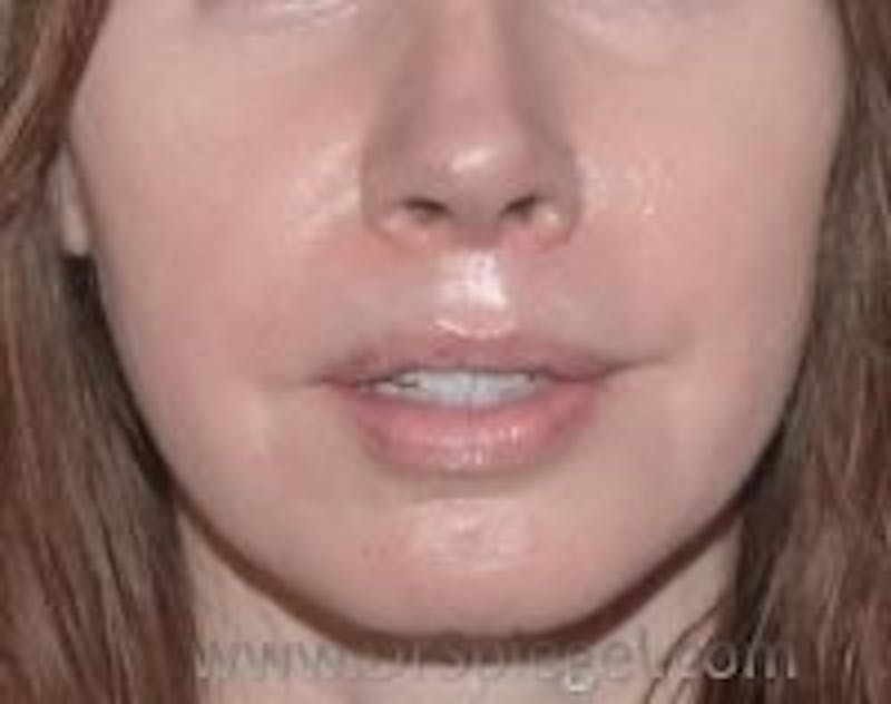 Lip Lift Before & After Gallery - Patient 326649 - Image 2
