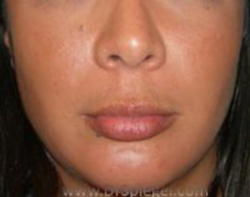 Lip Lift Before & After Gallery - Patient 375670 - Image 1