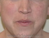 Lip Lift Before & After Gallery - Patient 219842 - Image 1