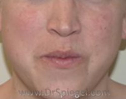 Lip Lift Before & After Gallery - Patient 219842 - Image 1
