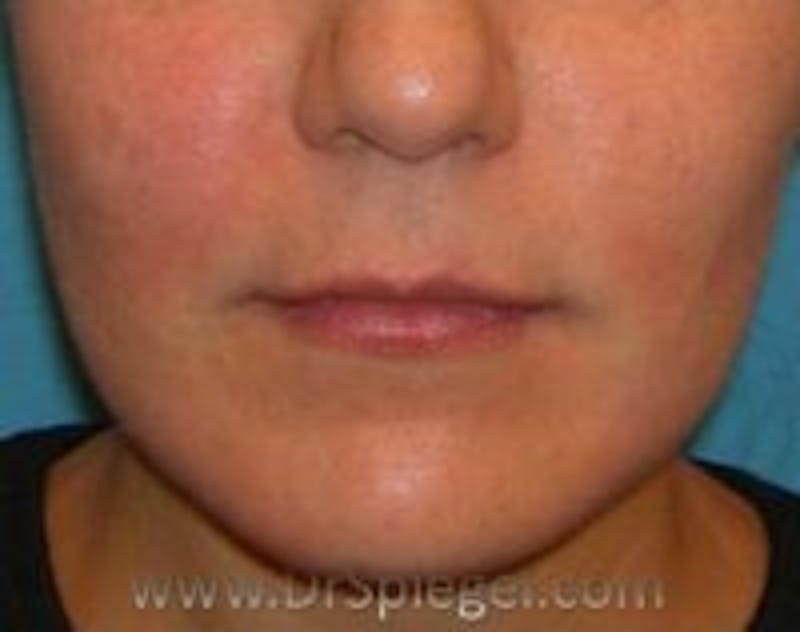 Lip Lift Before & After Gallery - Patient 345732 - Image 1