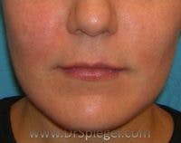 Lip Lift Before & After Gallery - Patient 345732 - Image 1