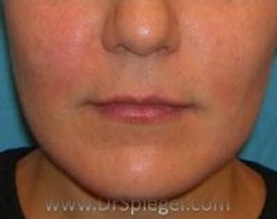Lip Lift Before & After Gallery - Patient 345732 - Image 1
