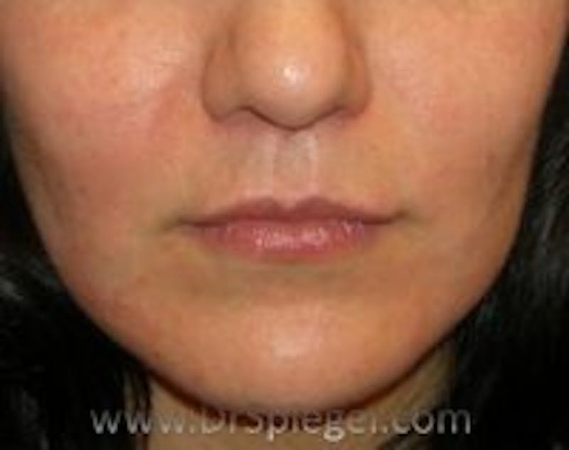 Lip Lift Before & After Gallery - Patient 345732 - Image 2