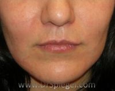 Lip Lift Before & After Gallery - Patient 345732 - Image 2