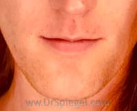 Lip Lift Before & After Gallery - Patient 383484 - Image 1