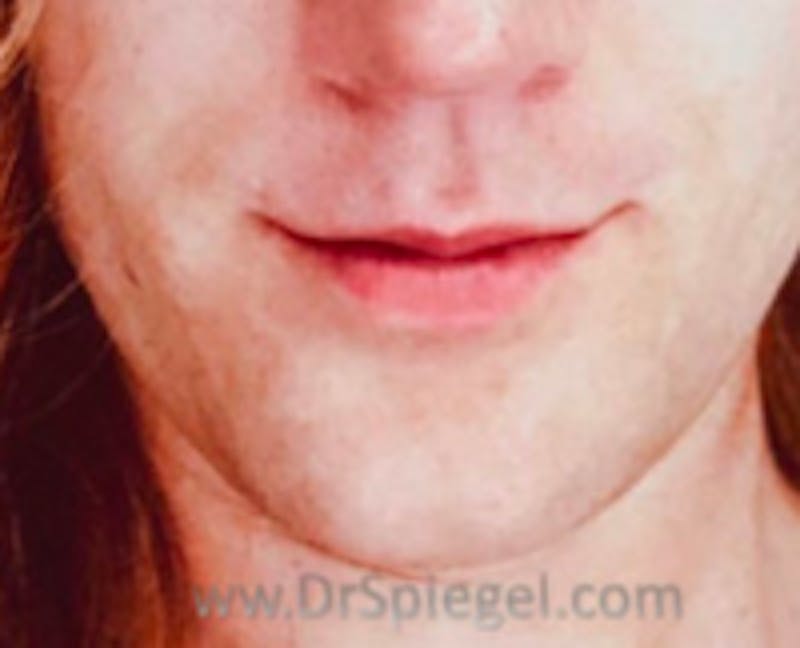 Lip Lift Before & After Gallery - Patient 383484 - Image 2