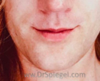 Lip Lift Before & After Gallery - Patient 383484 - Image 2