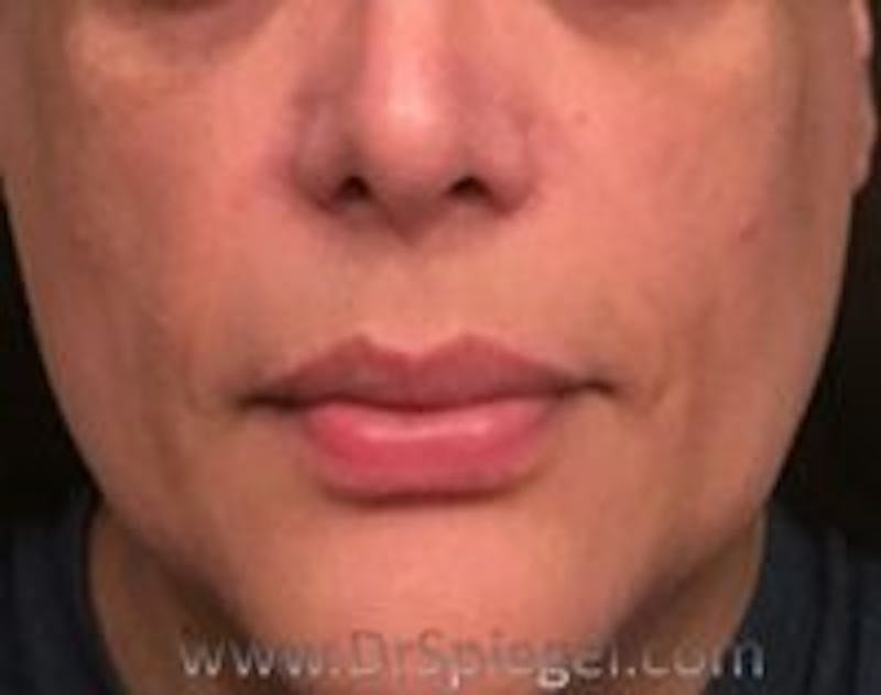 Lip Lift Before & After Gallery - Patient 334914 - Image 1