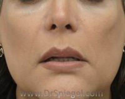 Lip Lift Before & After Gallery - Patient 334914 - Image 2