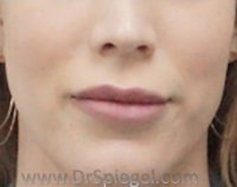 Lip Lift Before & After Gallery - Patient 320666 - Image 1