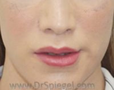 Lip Lift Before & After Gallery - Patient 320666 - Image 2
