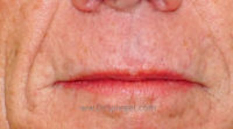 Lip Lift Before & After Gallery - Patient 342320 - Image 1