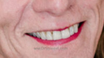 Lip Lift Before & After Gallery - Patient 342320 - Image 2