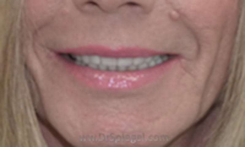 Lip Lift Before & After Gallery - Patient 127991 - Image 1