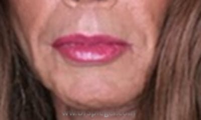Lip Lift Before & After Gallery - Patient 127991 - Image 2